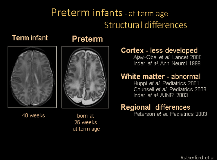 Showing infant term vs preterm brain scans and cortex, white matter and regional differences