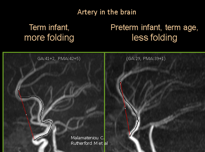 Two images comparing the brain arteries of a term infant and a preterm infant, term age. The term infant's brain artery shows more folding than the preterm infant's.