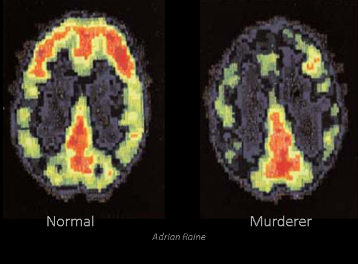 MRI scan of two brains: one normal, one of a murderer showing apparent differences.