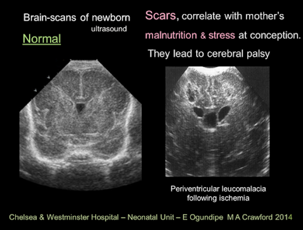 Ultrasounds of brain scans showing scars corresponding to mother's malnutrition and stress at conception